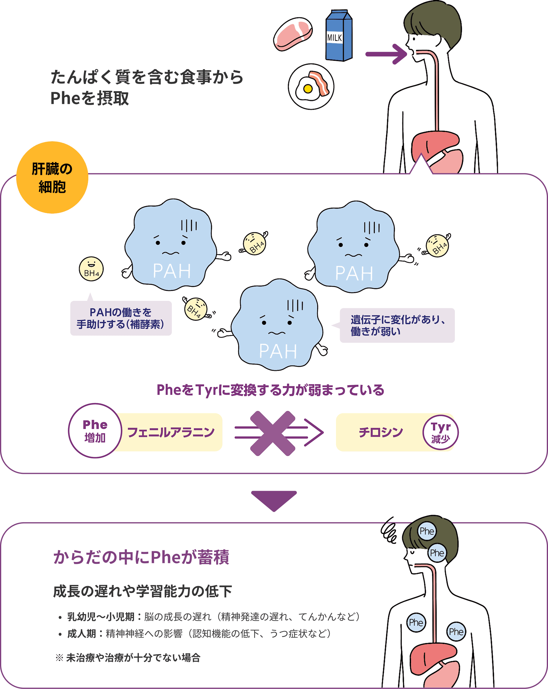 たんぱく質を含む食事からPheを摂取 肝臓の細胞 PAHの働きを手助けする（補酵素） 遺伝子に変化があり、働きが弱い PheをTyrに変換する力が弱まっている Phe増加 フェニルアラニン Tyr減少 チロシン　からだの中にPheが蓄積 成長の遅れや学習能力の低下 ・乳幼児〜小児期：脳の成長の遅れ（精神発達の遅れ、てんかんなど） ・成人期：精神神経への影響（認知機能の低下、うつ症状など） ※未治療や治療が十分でない場合